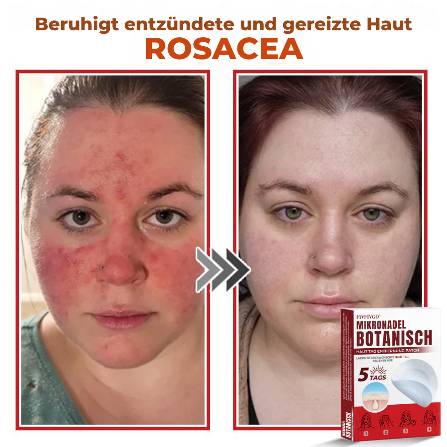 Fivfivgo® MikroNadel Botanisch Haut Tag Entfernung Patch 🇩🇪 Hergestellt in der Germany