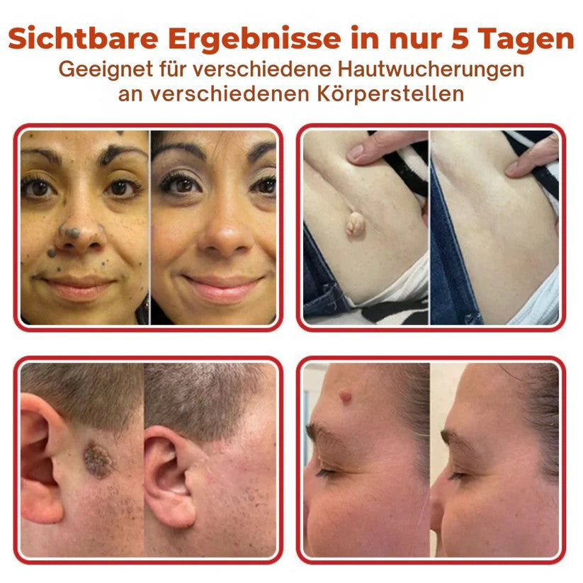 Oveallgo® MikroNadel Botanisches Tag-Clear-Pflaster Pro 🇩🇪 Hergestellt in der Germany