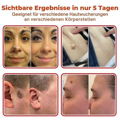 Oveallgo® MikroNadel Botanisches Tag-Clear-Pflaster Pro 🇩🇪 Hergestellt in der Germany