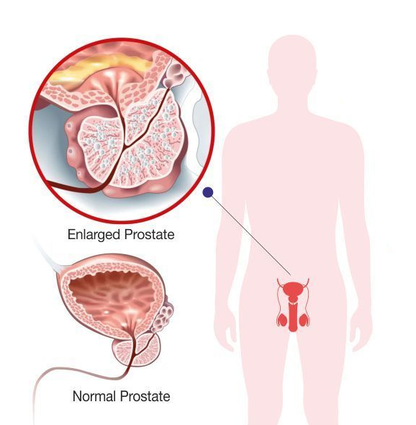 Oveallgo™ Prostate Nocturia Care Patch